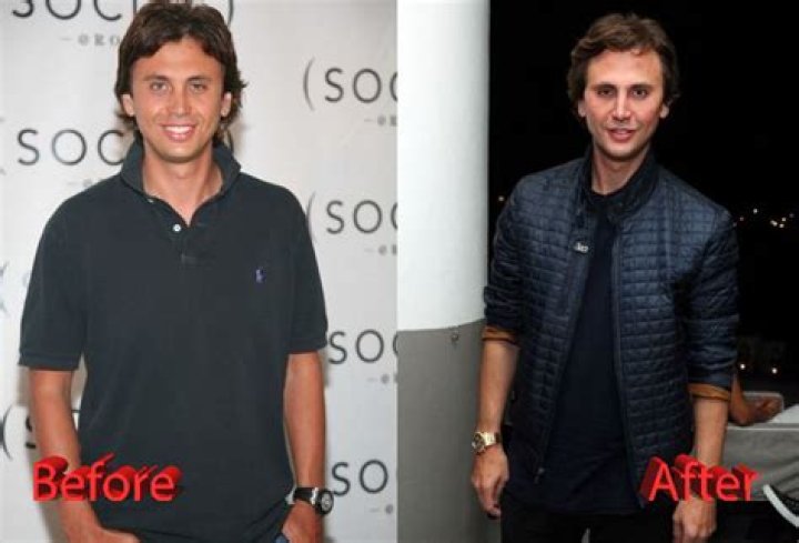 Jonathan Cheban Plastic Surgery